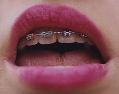 Harley Weir #photography #mouth #braces