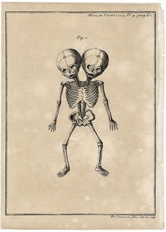 Morbid Anatomy #twins #illustration #medical