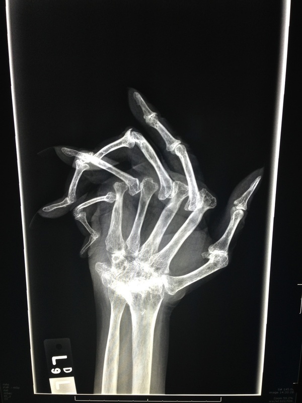 http://i.imgur.com/Css7WcH.jpg #hand #xray