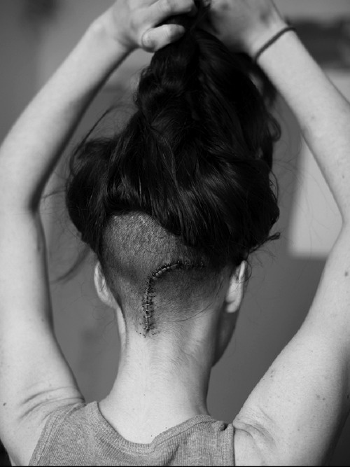 Portrait, unknown. #white #scar #black #hair #stitches #portrait