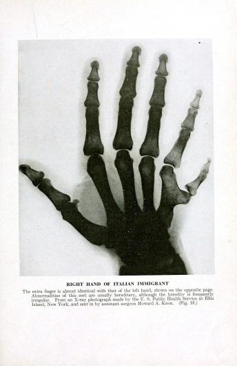 X-Ray-Hand-with-Extra-Finger.jpg (1218×1876) #finger #deformed #ray #hand