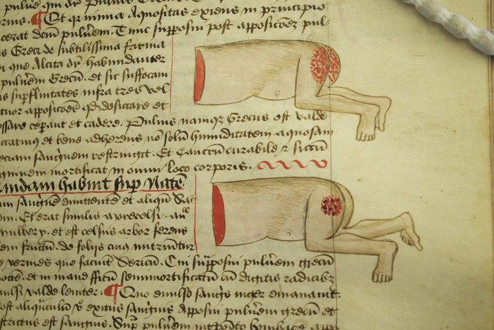 Illustrations from John of Arderne's medical treatise Mirror of Phlebotomy & Practice of Surgery.