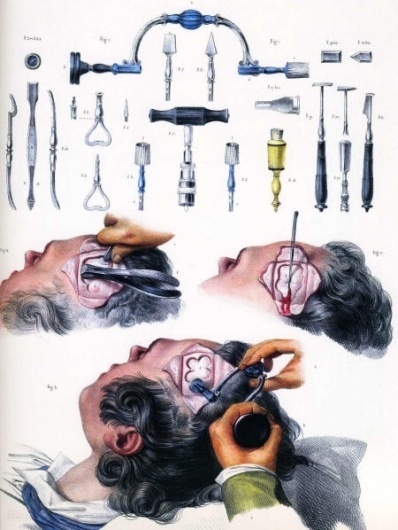 Morbid Anatomy #operation #head #illustration #stools #medical