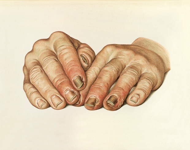 The hands of a patient , showing paronychia, an infection, an infection of the nails associated with tertiary syphilis. #morbid #hands #macabre #anatomical #anatomy #medicine #infection #illustration #vintage #study #nails #drawing