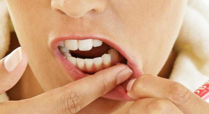 A gum abscess is an infection that is located between the tooth root and the gingiva tissue. You can see a gum boil in your mouth at the gum line point or deep in the periodontal pockets created by the bacteria. The boil is filled with pus and it cause a lot of pain because of the inner pressure. As soon as the dentist will drain the abscess, the relief is immediate but the therapy require additional medication and, in some cases, antibiotics.