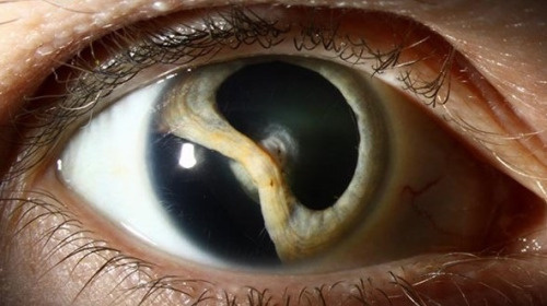 eye closeup