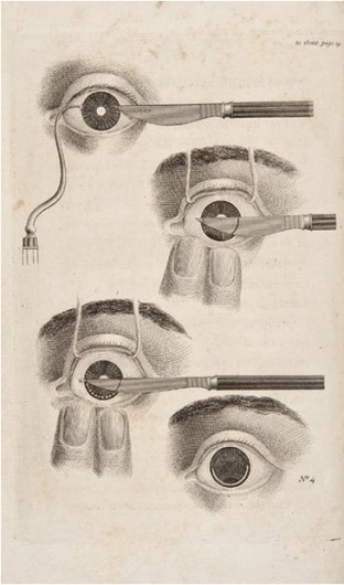 Morbid Anatomy: February 2010 #medical #eye #cut #etching